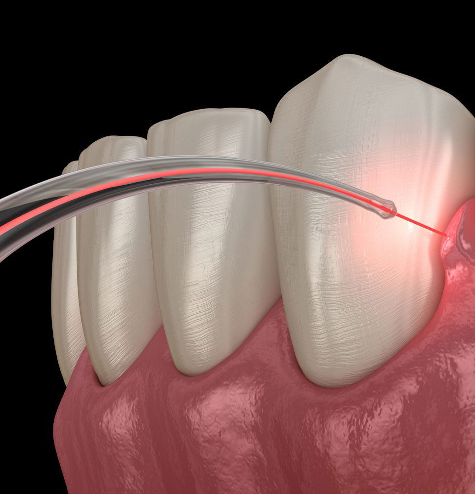 dental laser being used for gum disease