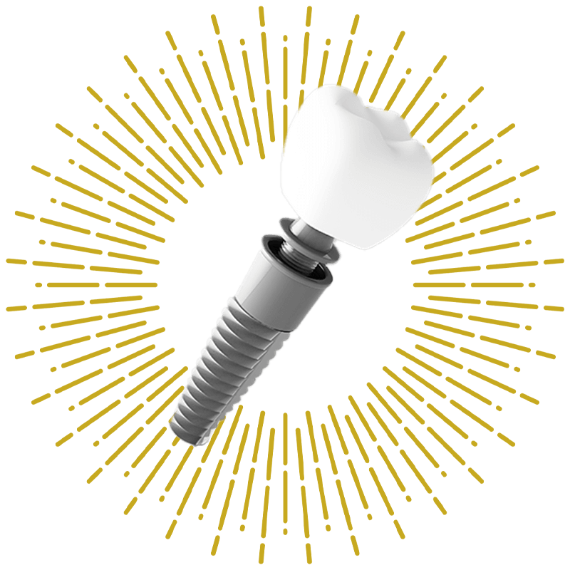 close up illustration of dental implant asset