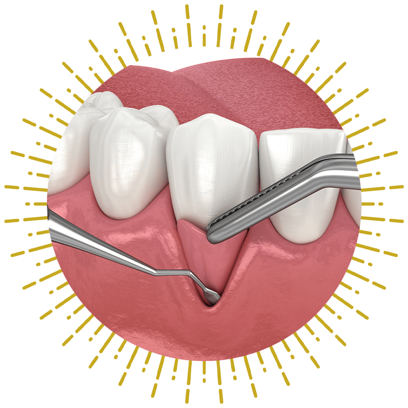 close up illustration of gum grafting surgery