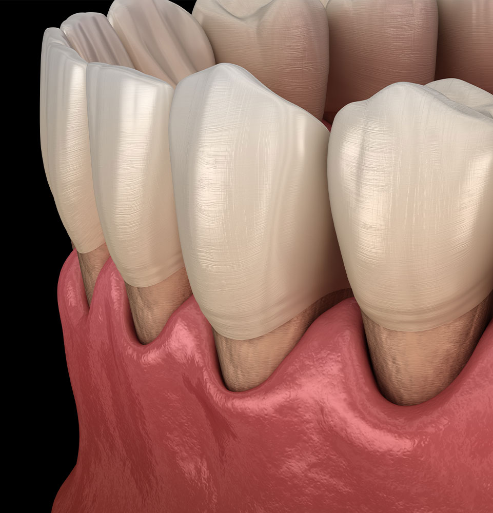 illustration close up of gum recession