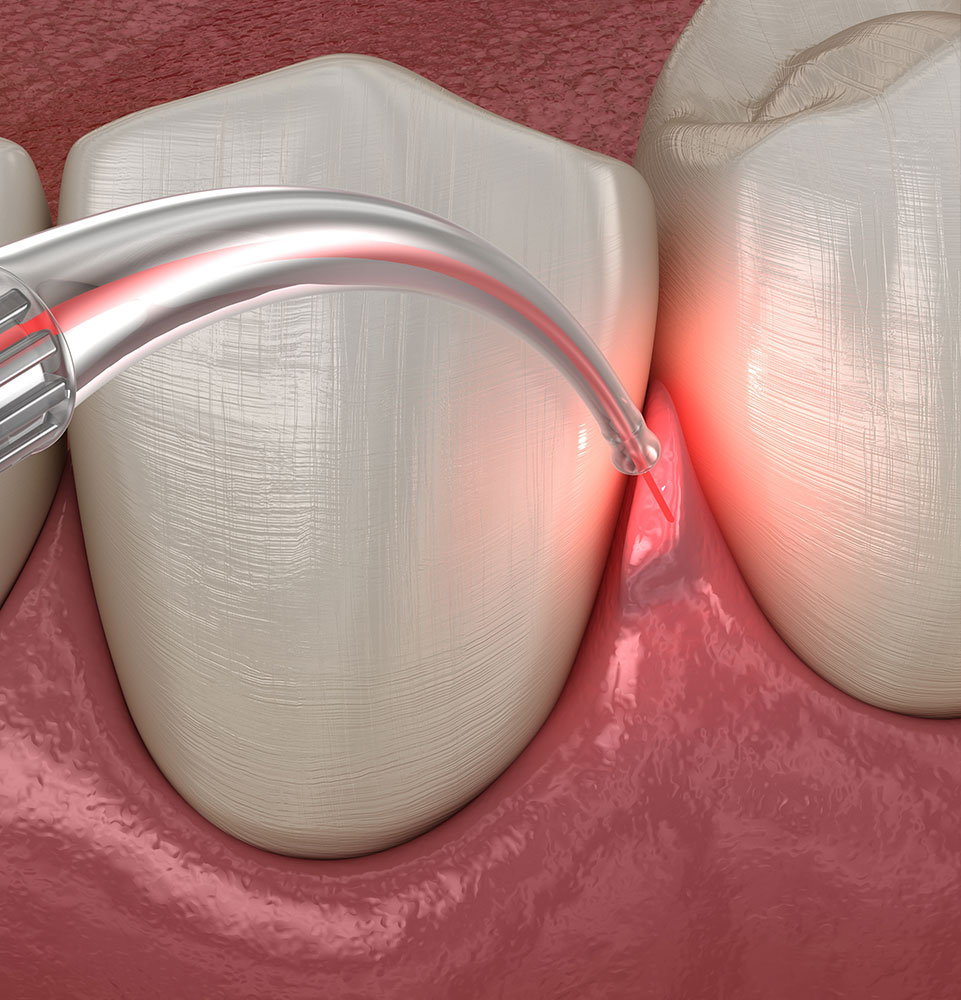 close up illustration of laser dentistry