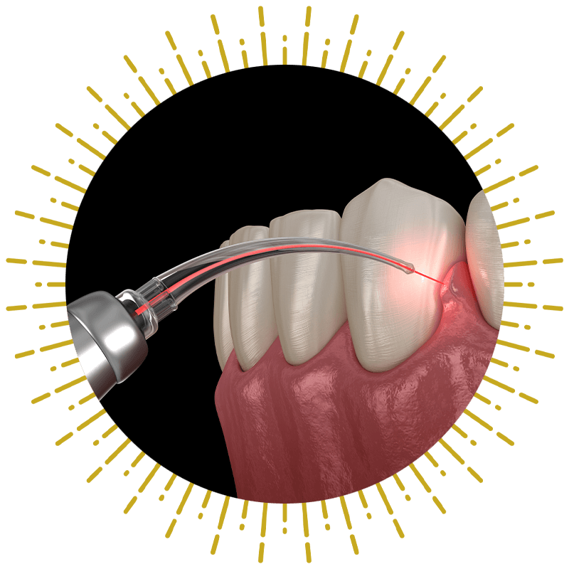 laser dentistry illustration