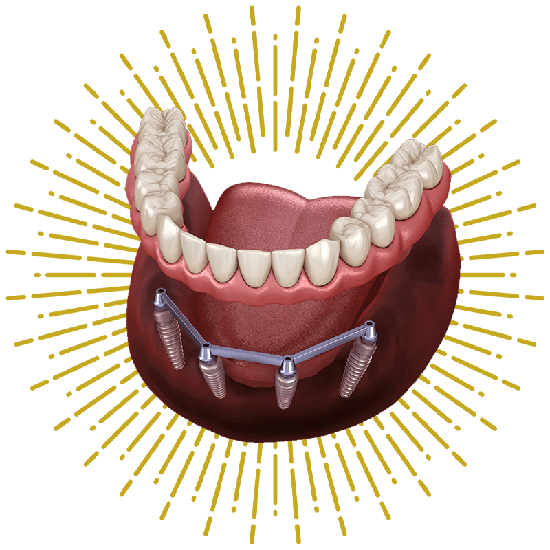 all on 4 implants