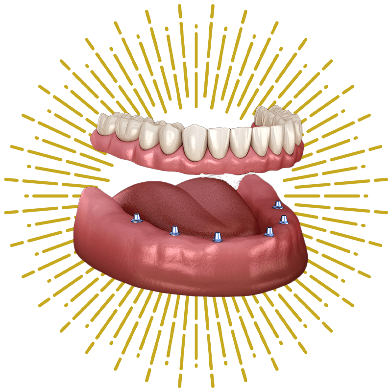 graphic over dentures
